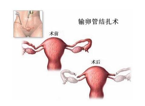 试管婴儿费用